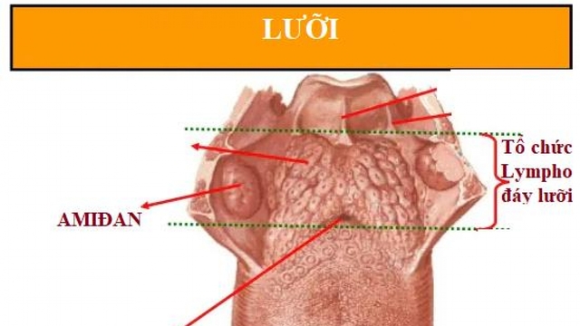 Nốt đỏ ở sau lưỡi và đáy lưỡi, có phải bị ung thư không?