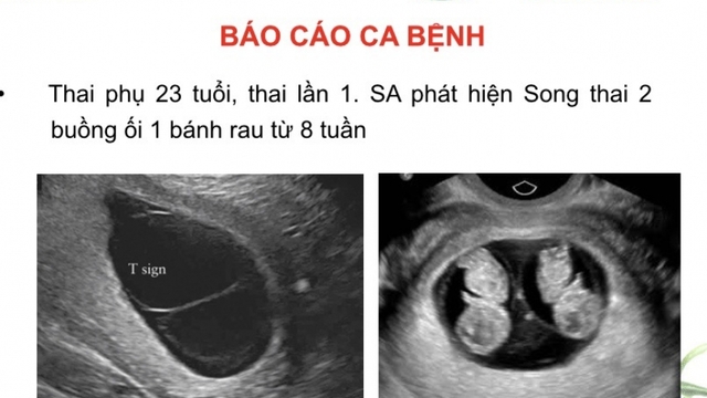 Công bố ca song thai cùng trứng cực kỳ đặc biệt, lần đầu ghi nhận tại Việt Nam
