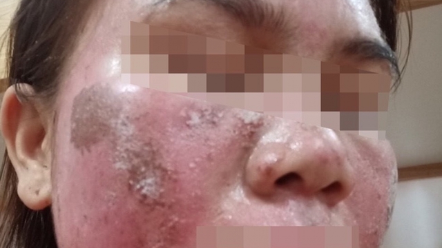 Mặt bỏng rát, bong tróc như da rắn sau khi bôi thuốc tại spa