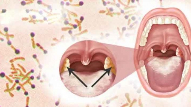 Three die of diphtheria in Vietnam