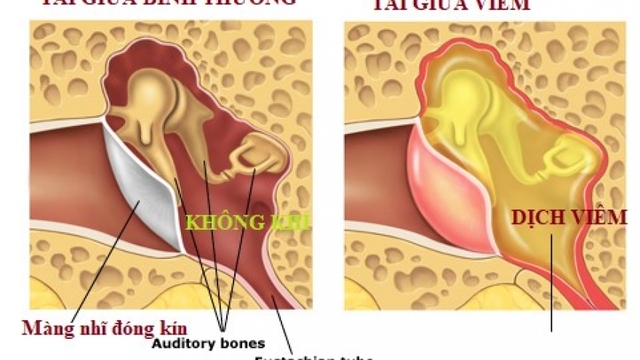 Vì sao thời gian điều trị viêm tai giữa thường kéo dài nhiều tuần?