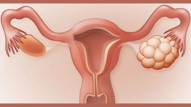 Buồng trứng đa nang có ảnh hưởng đến khả năng sinh sản không?