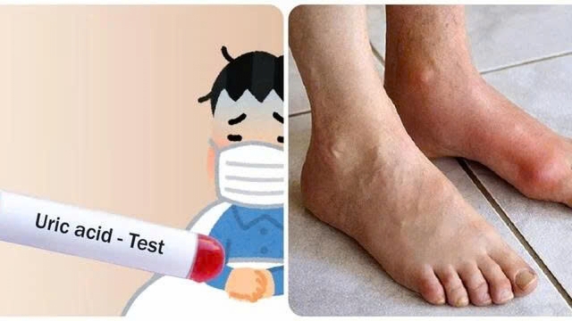 Axit uric là nguồn cơn gây ra nhiều bệnh nguy hiểm