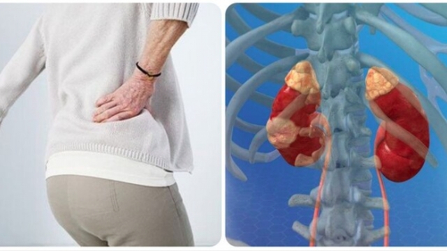 Triệu chứng ung thư thận giai đoạn cuối