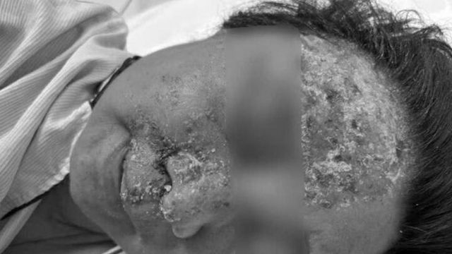 Nổi mụn nước tưởng dị ứng da, không ngờ nhiễm virus gây biến chứng nguy hiểm