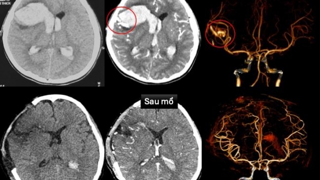 Cứu bệnh nhi bị dị dạng mạch máu não kèm bệnh cơ tim xốp hiếm gặp