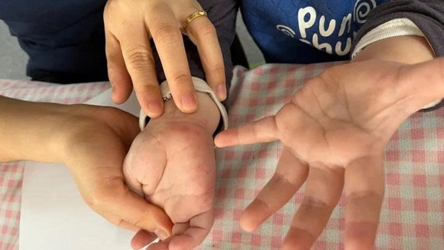 Tưởng con sốt phát ban, bà mẹ tá hỏa khi bác sĩ kết luận tay chân miệng