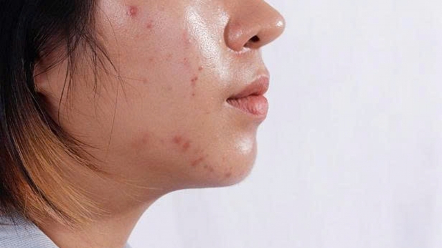 Bí quyết làm sạch dầu trên da mặt mà nhiều người bỏ qua