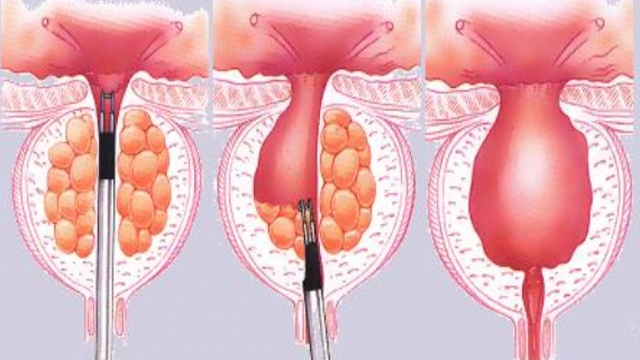 Những nguy cơ cần lưu ý sau khi phẫu thuật cắt tiền liệt tuyến