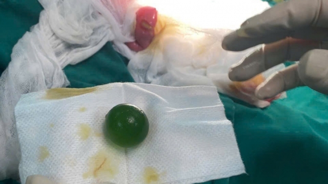 Cấp cứu thành công bệnh nhi tắc đường ruột do nuốt phải hạt nở