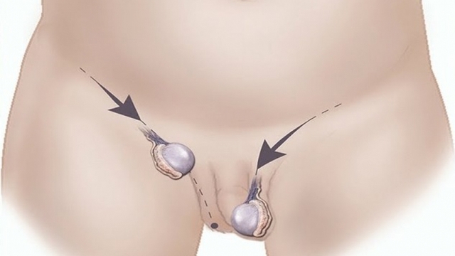 Trẻ 9 tháng chỉ có 1 tinh hoàn, để lớn mới khám hay can thiệp ngay?