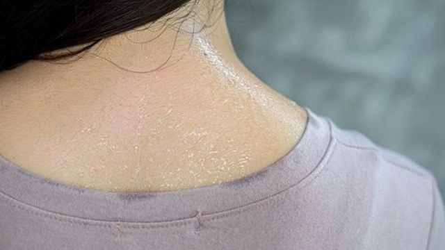 Mồ hôi muối: Bình thường hay cảnh báo sức khỏe tiềm ẩn?