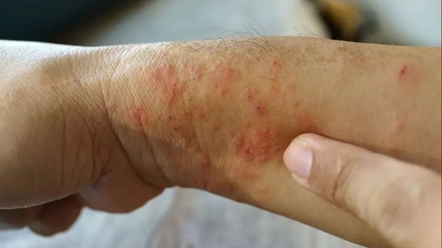 Bệnh "sốt đất" khiến 23 người ở Thái Lan tử vong: Bộ Y tế khuyến cáo