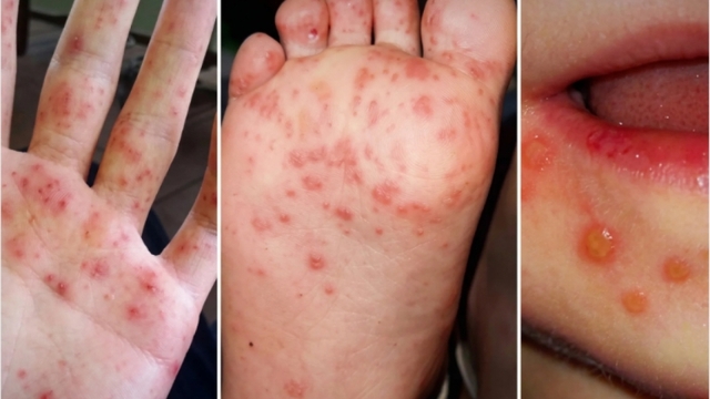 Cảnh báo từ chủng EV71 và giải pháp giảm ca nặng