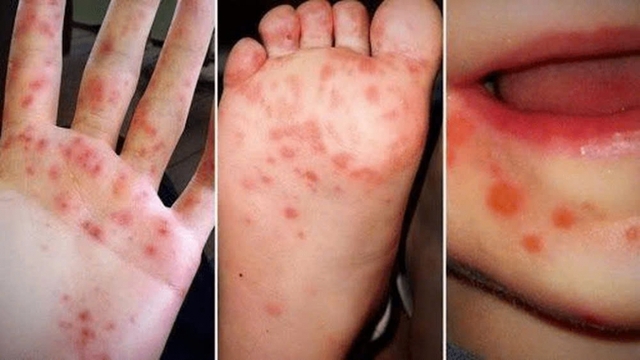 Bệnh tay chân miệng: Số ca bệnh nặng có thể tiếp tục gia tăng