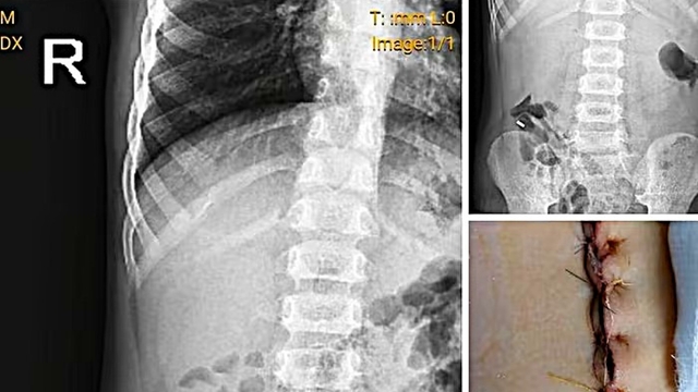 Bệnh viện Sản Nhi Nghệ An thông tin vụ phẫu thuật dị vật cho bé trai gây xôn xao