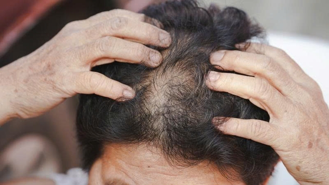 Vì sao phụ nữ trung niên dễ rụng tóc và có cách nào khắc phục?