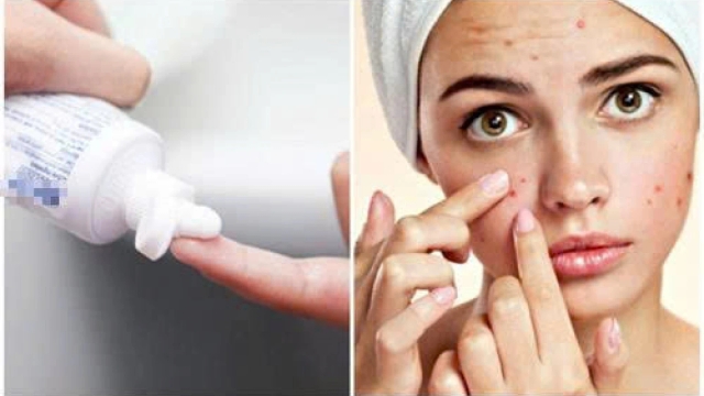 Bôi kem đánh răng lên mụn có giúp da nhanh sạch hay gây hại?