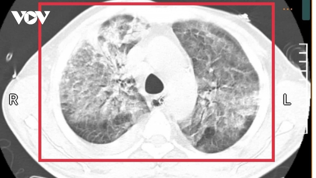 Người đàn ông trở về từ Thái Lan mang theo "vi khuẩn tử thần"