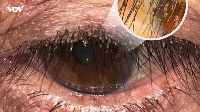 Mắt đau ngứa đi khám, hoảng hốt phát hiện rận mu bám dày đặc trên lông mi