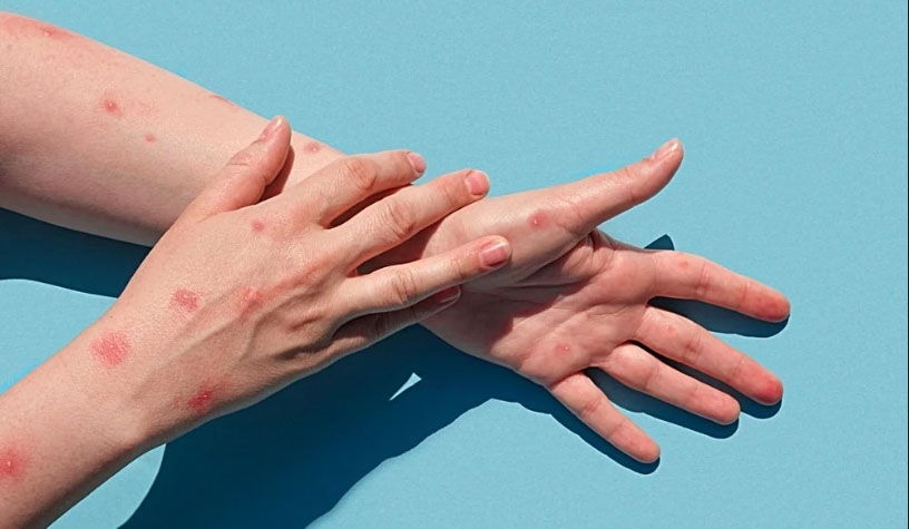 A monkeypox case will develop symptoms such as acute rash, fever, swollen lymph nodes, headache, muscle pain, back pain, and asthenia (Photo: Marina Demidiuk/Shutterstock)