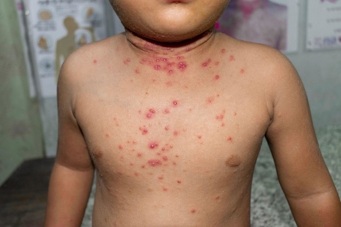 A child gets infected with monkeypox