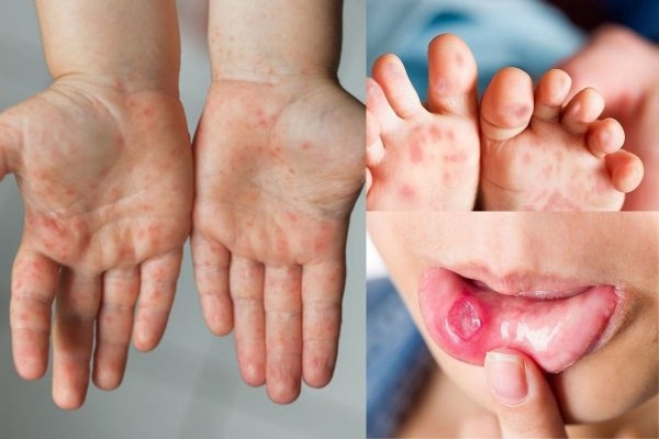 Symptoms of HFMD include fever, mouth sores, and skin rash (Photo: Inrternet)