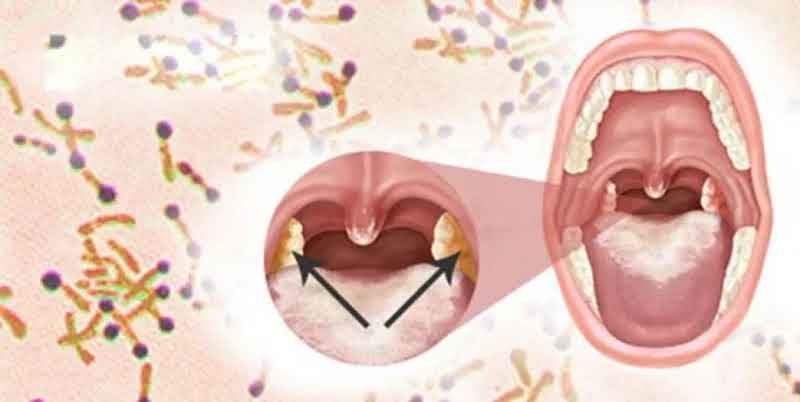 Diphtheria is an infection caused by the bacterium Corynebacterium diphtheria