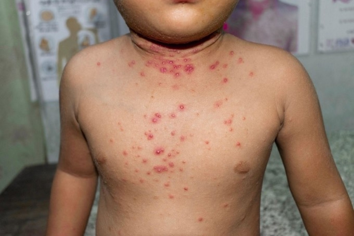 A child gets infected with monkeypox (Photo: Internet)