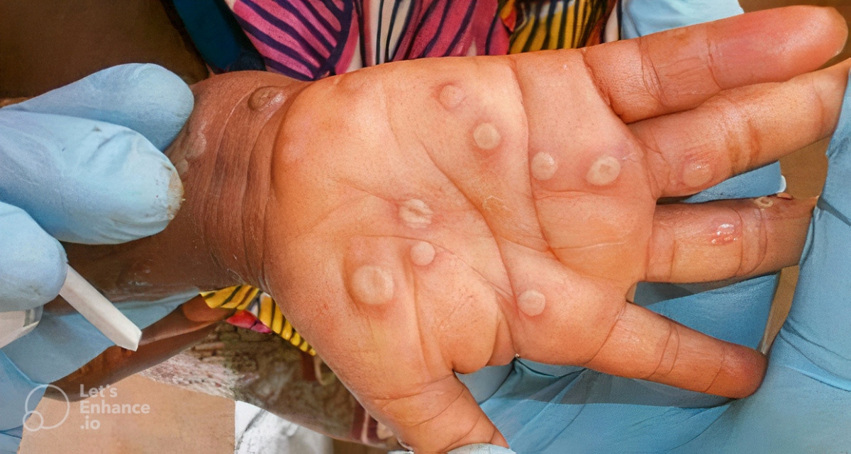 A hand of a patient with monkeypox - illustrative image
