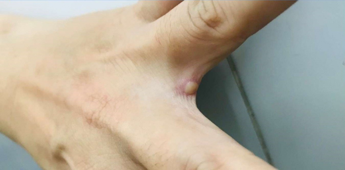 The patient suffers from several blisters, which is one of the main symptoms of monkeypox (Photo: Vietnamnet)
