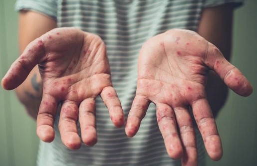 Hands of a patient with skin lesions due to monkeypox (Photo: nld.com.vn)