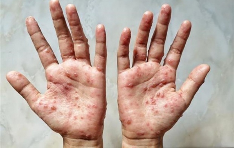 Da Nang detects a suspected monkeypox case (Photo: Internet)