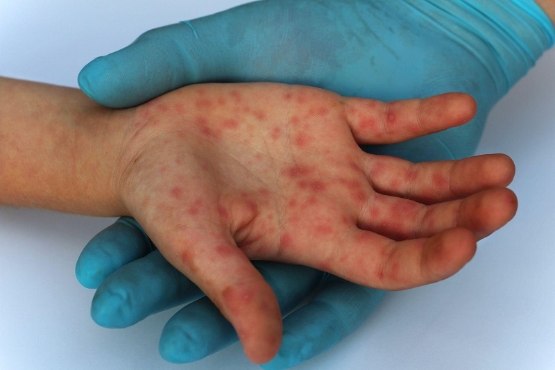 A hand of a patient with monkeypox