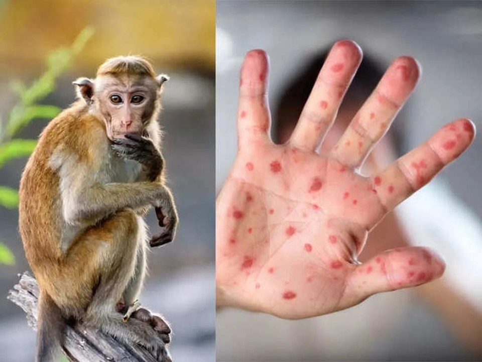 A monkeypox case will develop symptoms such as acute rash, fever, swollen lymph nodes, headache, muscle pain, back pain, and asthenia (Photo: kinhtedothi.vn)