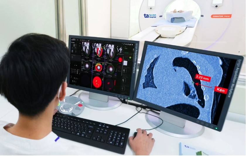 A CT scan from the Somatom Force VB30 reveals a ruptured pulmonary cyst with an ultra-small diameter of just 2mm in a pediatric patient (Photo source: Tam Anh General Hospital)