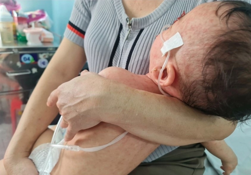 Many children require ventilators due to measles-related pneumonia complications