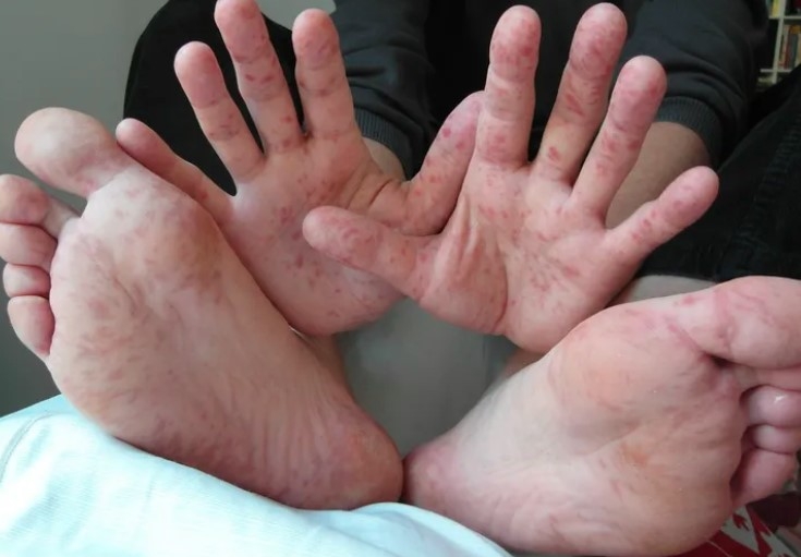 Ho Chi Minh City reports increase in hand, foot, and mouth cases (Photo: Internet)