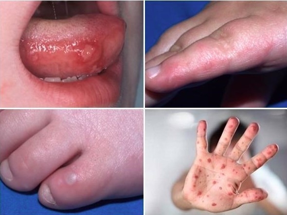 More fresh HFMD outbreaks recorded in Hanoi
