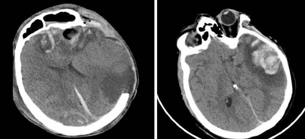 Brain CT scans of the two Russian patients (Photo: People’s Hospital 115)