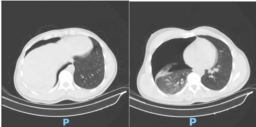 A chest CT scan identifies a large right-sided pneumothorax compressing the lung (Photo: People's Hospital 115)